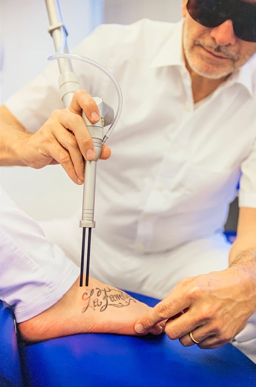 Tattooentfernung mit dem Laser